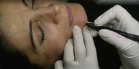 Skin imperfection treatment