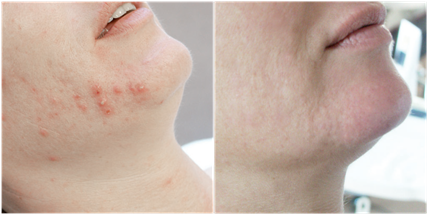 Before and after the acne treatment