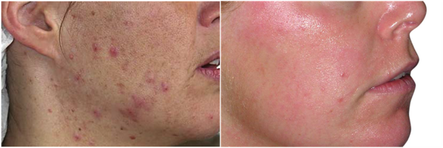 Before and after the acne treatment 2