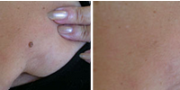 Skin imperfection before after