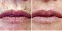 Before and after the Mesotherpie treatment