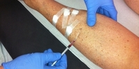 Varicose vein removal 2