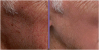 Before and after the rosacea treatment