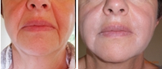 Before and after the Mesotherpie treatment 2