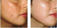 Microdermabrasion before and after