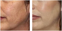 Microdermabrasion before and after