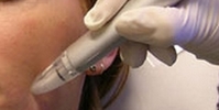 Microdermabrasion