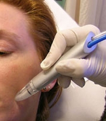 Microdermabrasion