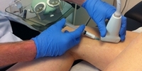 Varicose vein treatment