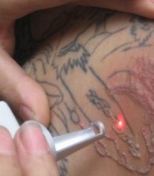 Tattoo removal